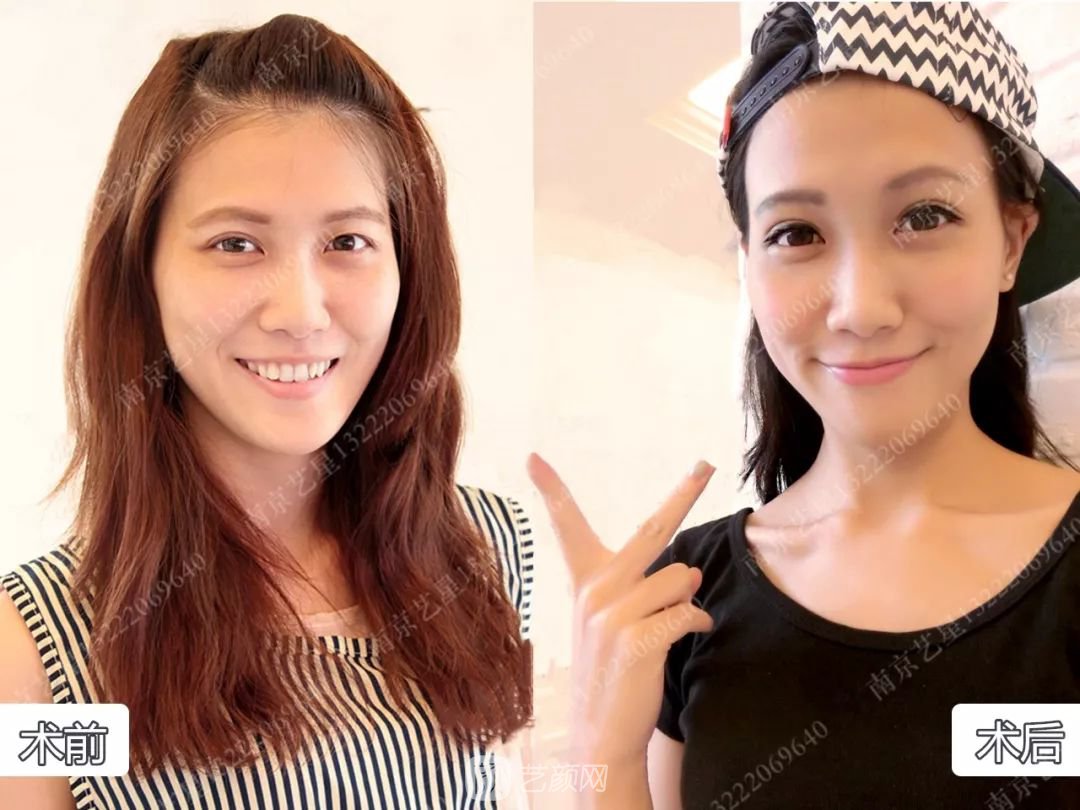 Yestar美杜莎美眼術一周案例圖片，芭比雙眼皮果很好~