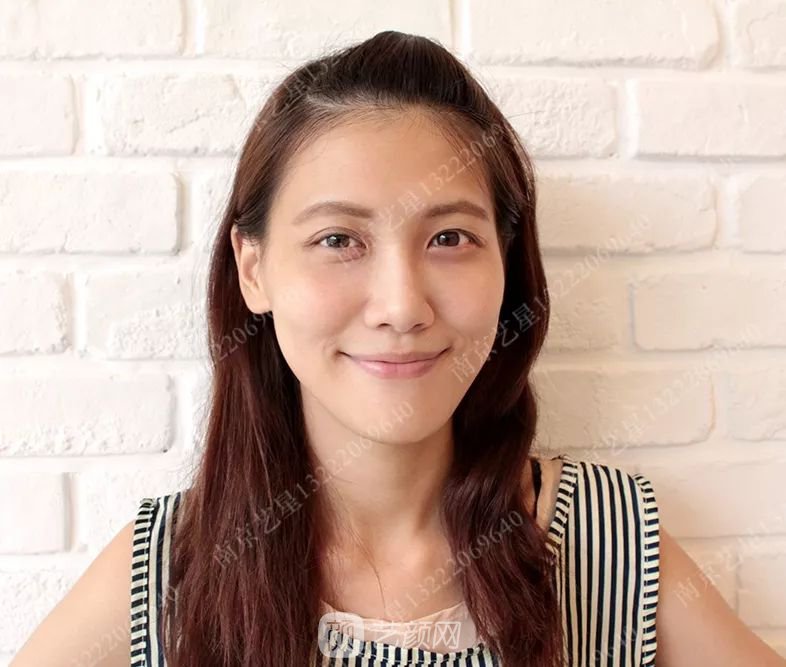 Yestar美杜莎美眼術一周案例圖片，芭比雙眼皮果很好~