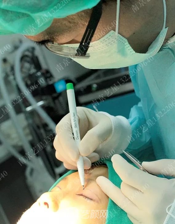 Yestar美杜莎美眼術一周案例圖片，芭比雙眼皮果很好~