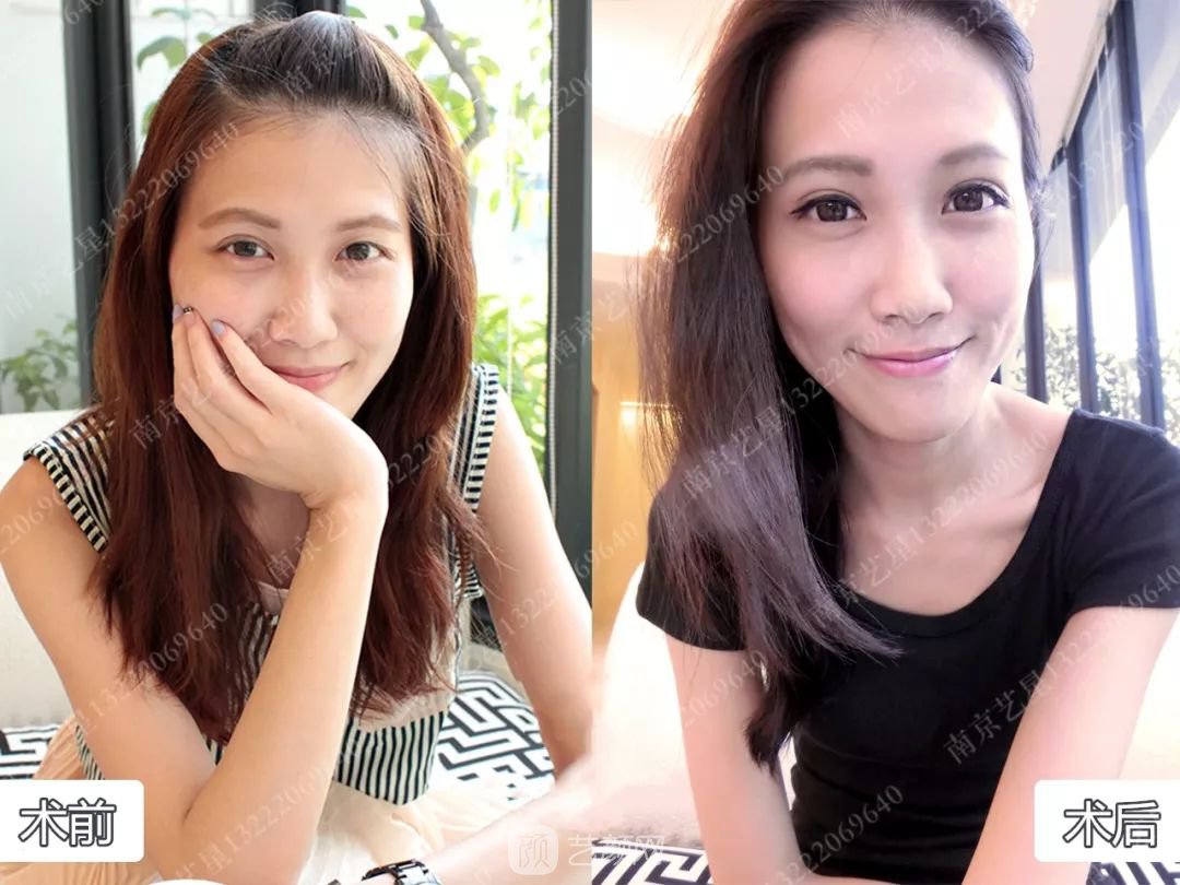 Yestar美杜莎美眼術一周案例圖片，芭比雙眼皮果很好~