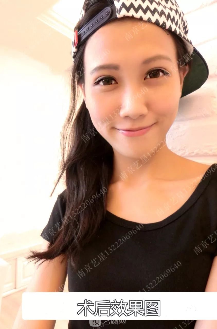 Yestar美杜莎美眼術一周案例圖片，芭比雙眼皮果很好~