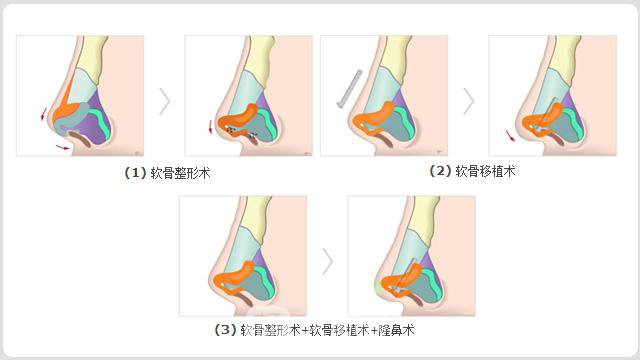 朝天鼻矯正大概要多少錢?