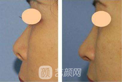 朝天鼻矯正大概要多少錢?