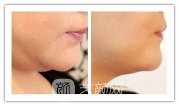 吸脂去雙下巴要多少錢?
