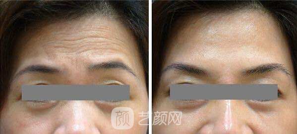 微晶瓷去抬頭紋多少錢?