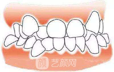 金鈀合金烤瓷牙價格多少?