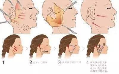 成都熱瑪吉拉皮除皺多少錢?