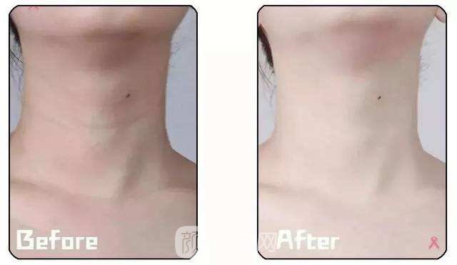 成都熱瑪吉拉皮除皺多少錢?