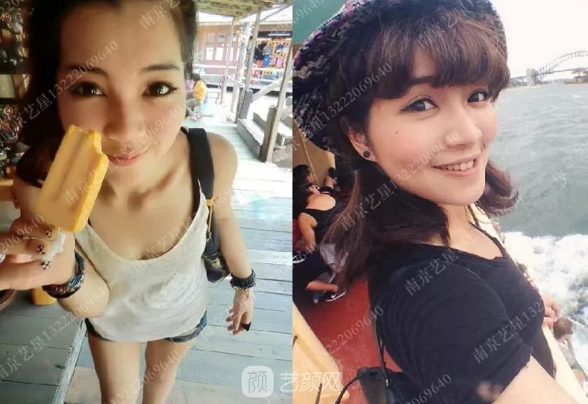 南京藝星自體脂肪豐胸術(shù)一個月案例分享~