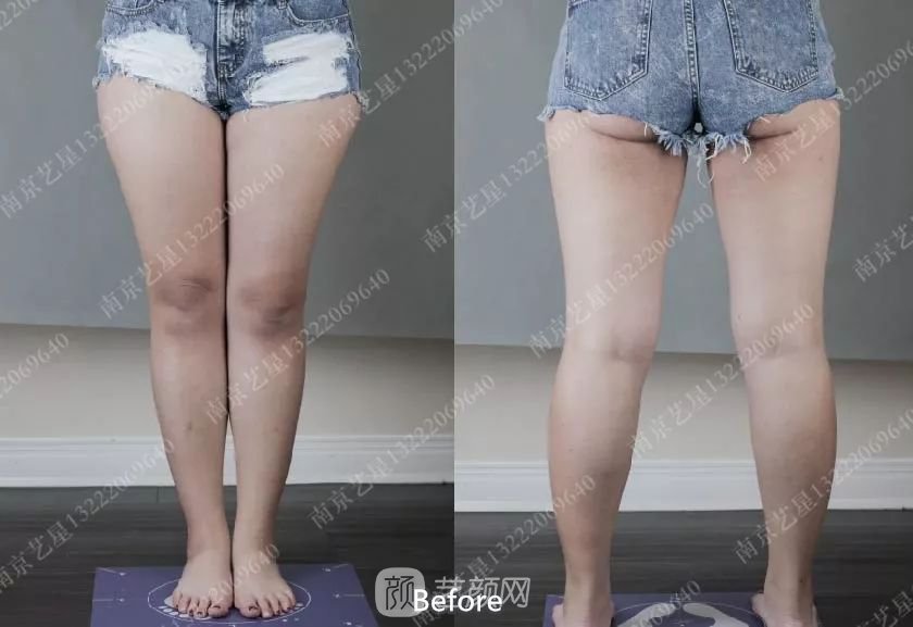 南京藝星自體脂肪豐胸術(shù)一個月案例分享~