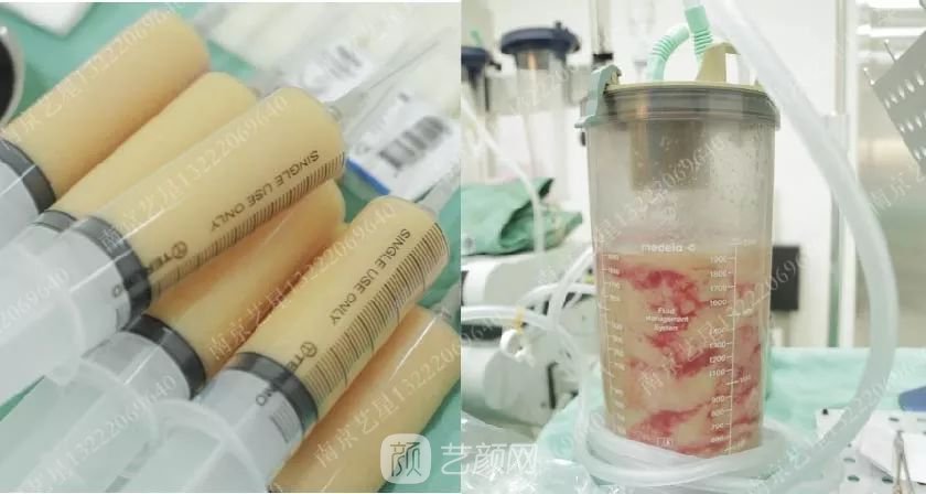 南京藝星自體脂肪豐胸術(shù)一個月案例分享~