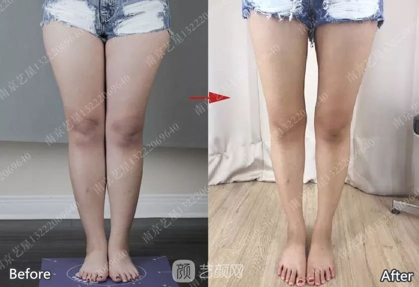 南京藝星自體脂肪豐胸術(shù)一個月案例分享~