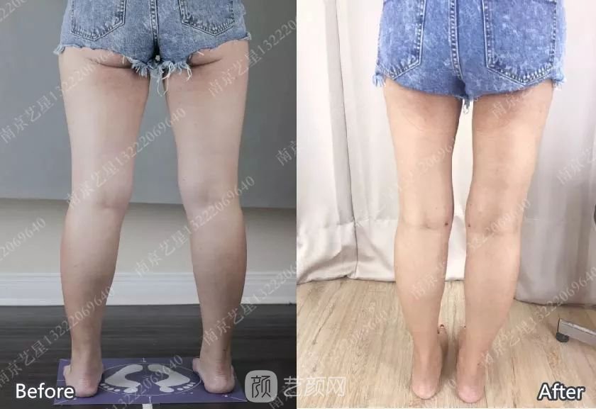 南京藝星自體脂肪豐胸術(shù)一個月案例分享~