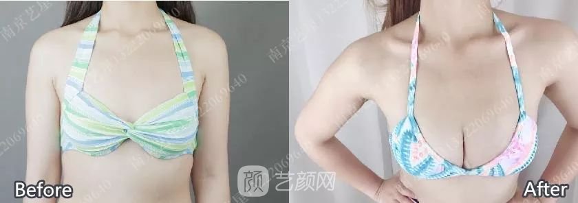 南京藝星自體脂肪豐胸術(shù)一個月案例分享~