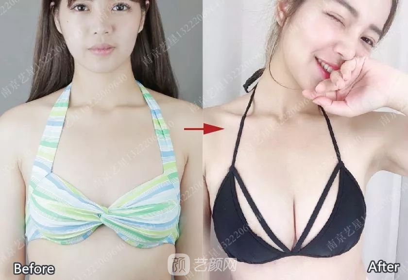 南京藝星自體脂肪豐胸術(shù)一個月案例分享~