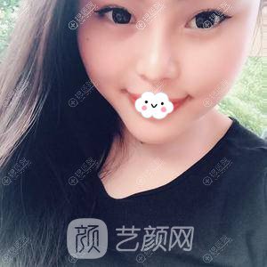 成都美容整形隆鼻+下巴整形真實案例恢復(fù)圖