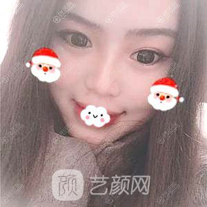 四川隆鼻哪家醫(yī)院好？成都成美馮春雨硅膠隆鼻+假體墊下巴恢復(fù)果圖