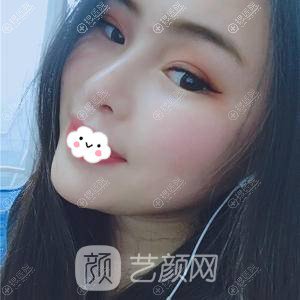 成都成美美容整形醫(yī)院假體隆鼻+墊下巴術(shù)后3個月果