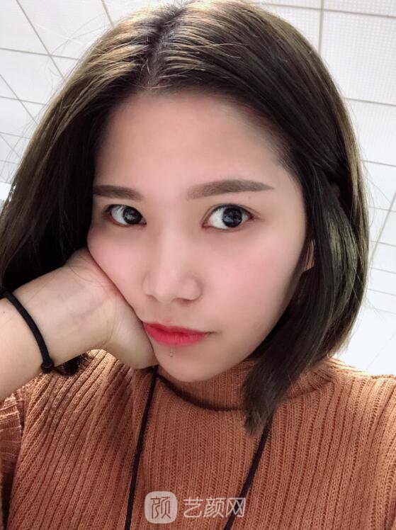 開眼角圖真實案例分享哦