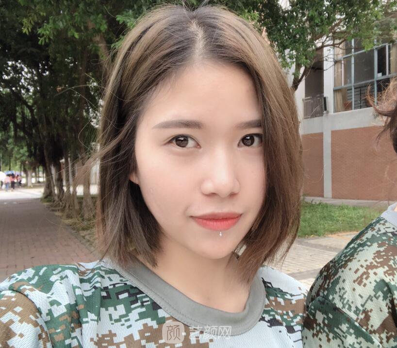 開眼角圖真實案例分享哦