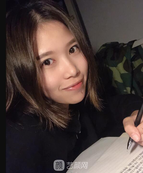 開眼角圖真實案例分享哦