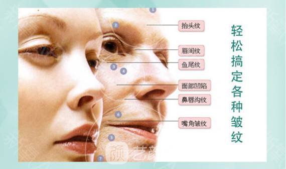 北京保妥-適除皺價格多少?