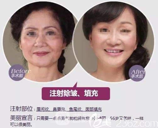 北京保妥-適除皺價格多少?