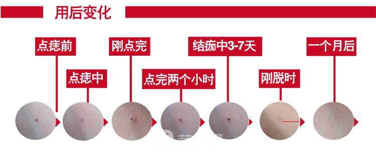 深圳激光去痣的價格是多少?