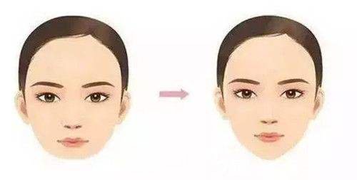 廣州玻尿酸墊下巴價格?