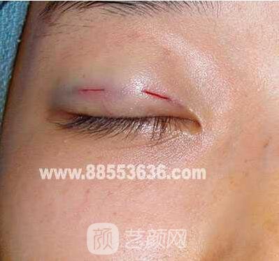 張嬌嬌醫(yī)生做的小切口雙眼皮手術(shù)案例