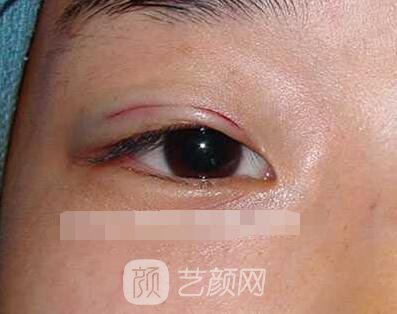 張嬌嬌醫(yī)生做的小切口雙眼皮手術(shù)案例