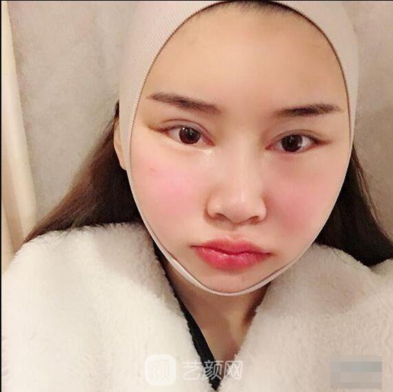 顴骨內(nèi)推真實案例，小臉網(wǎng)紅模板臉型