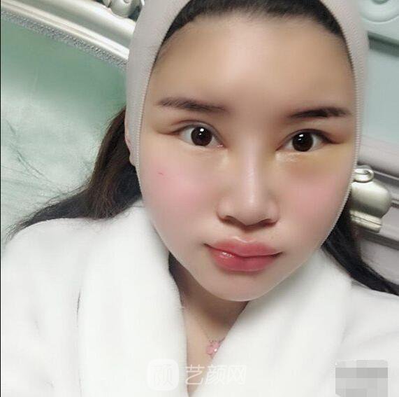 顴骨內(nèi)推真實案例，小臉網(wǎng)紅模板臉型