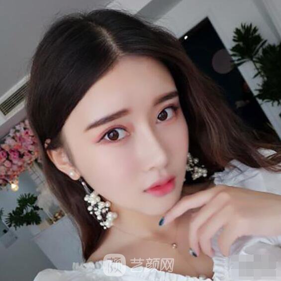 顴骨內(nèi)推真實案例，小臉網(wǎng)紅模板臉型