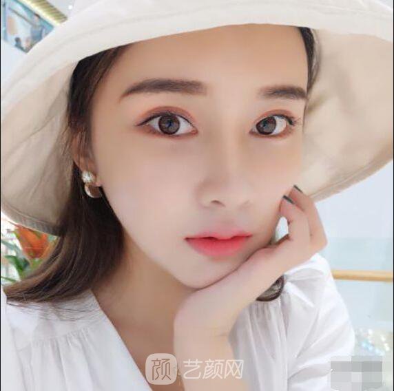 顴骨內(nèi)推真實案例，小臉網(wǎng)紅模板臉型