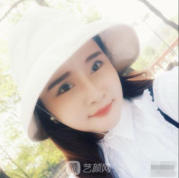 顴骨內(nèi)推真實案例，小臉網(wǎng)紅模板臉型