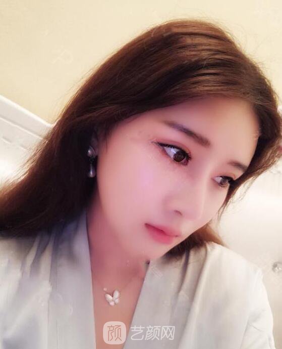 顴骨內(nèi)推真實案例，小臉網(wǎng)紅模板臉型