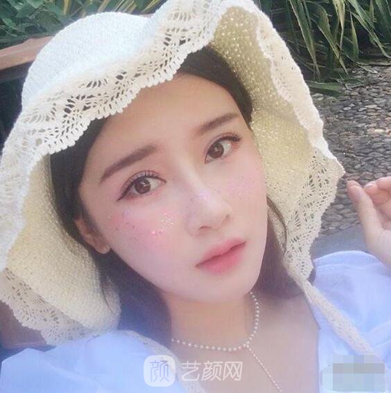 顴骨內(nèi)推真實案例，小臉網(wǎng)紅模板臉型