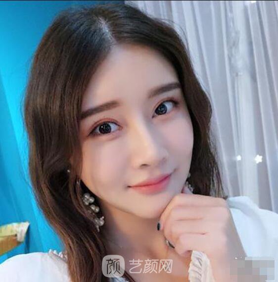 顴骨內(nèi)推真實案例，小臉網(wǎng)紅模板臉型