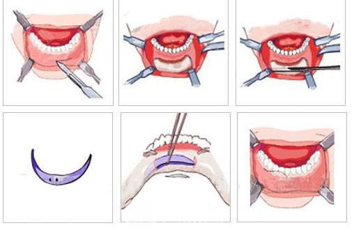 膨體墊下巴多少錢?