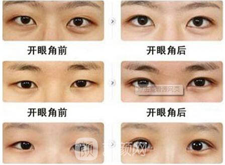 上海韓式開(kāi)眼角多少錢(qián)?