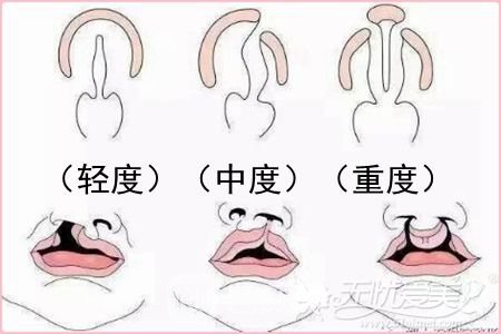 唇腭裂手術(shù)多少錢?