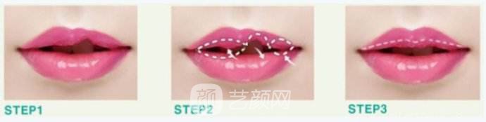 唇腭裂手術(shù)多少錢?