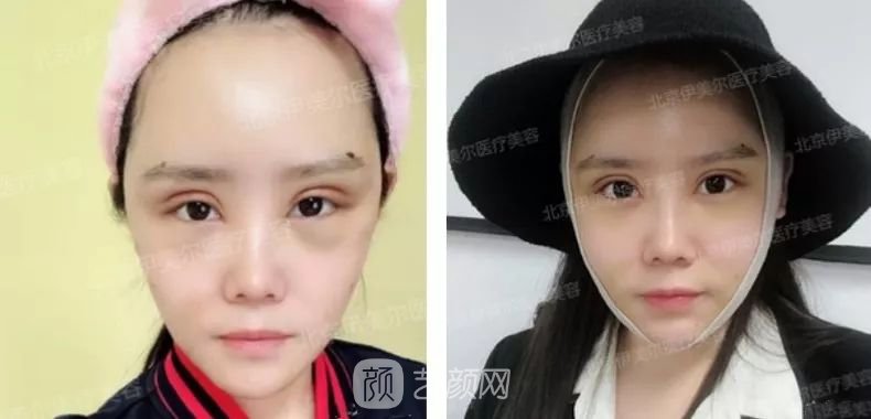 伊美爾幸福李輝靈動(dòng)面部年輕化術(shù)后兩個(gè)月恢復(fù)日記~