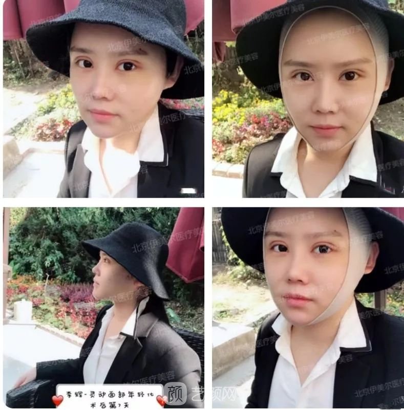 伊美爾幸福李輝靈動(dòng)面部年輕化術(shù)后兩個(gè)月恢復(fù)日記~