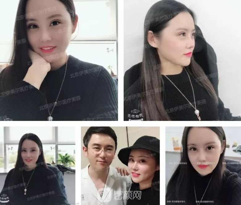 伊美爾幸福李輝靈動(dòng)面部年輕化術(shù)后兩個(gè)月恢復(fù)日記~