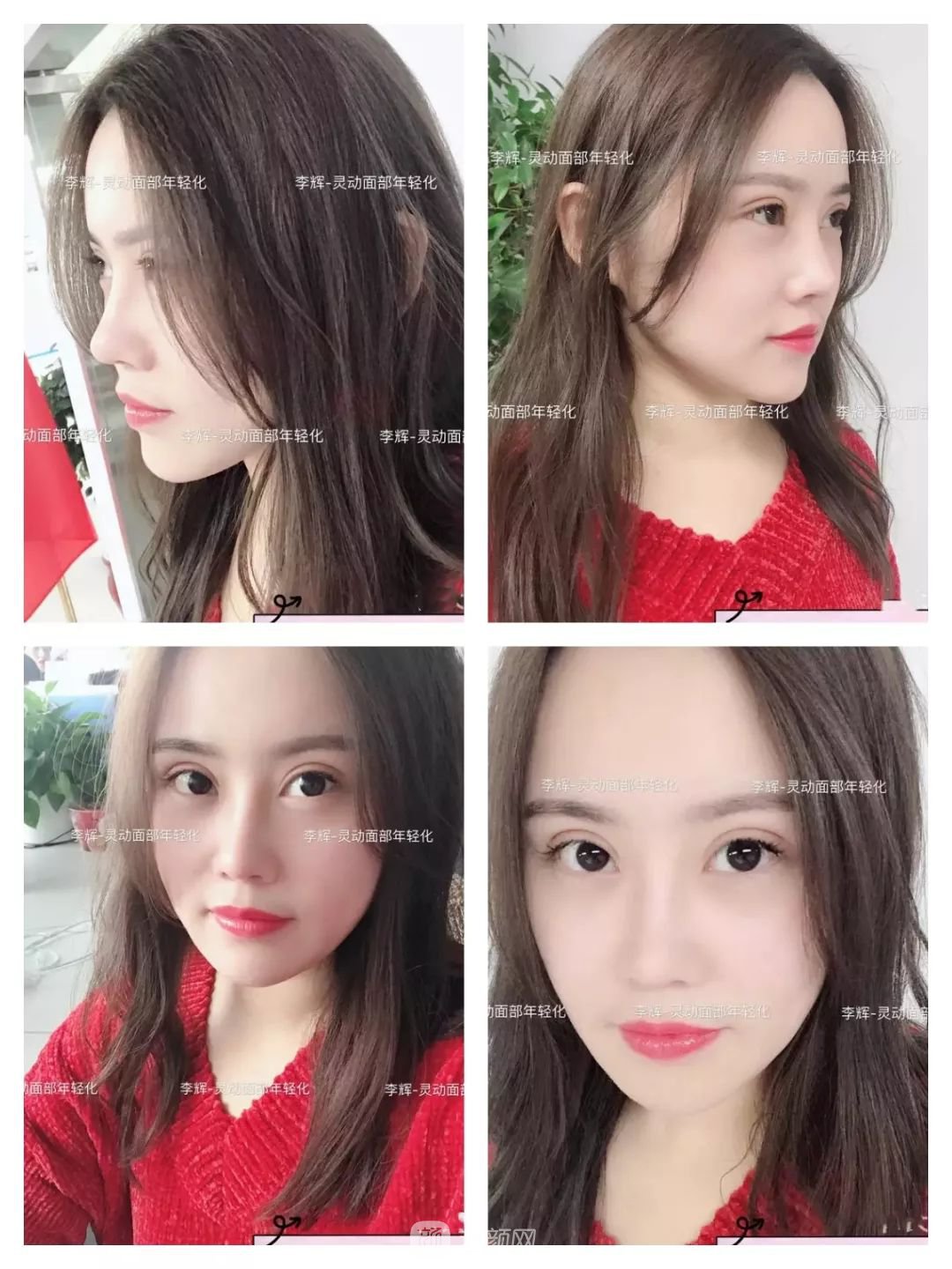 伊美爾幸福李輝靈動(dòng)面部年輕化術(shù)后兩個(gè)月恢復(fù)日記~