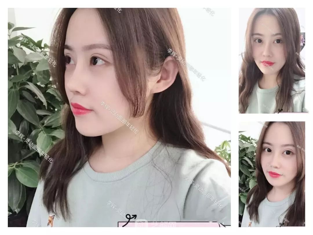 伊美爾幸福李輝靈動(dòng)面部年輕化術(shù)后兩個(gè)月恢復(fù)日記~