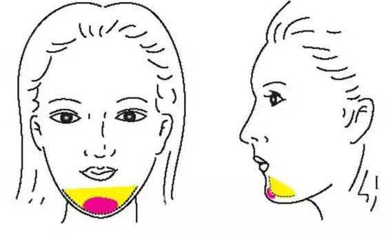 面部填充物取出要多少錢