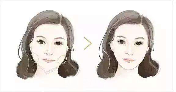 面部填充物取出要多少錢